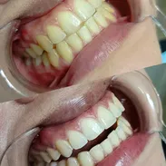 Blanquemientos Dentales - Img 55503550
