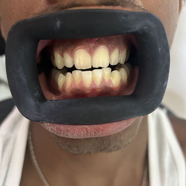 Blanqueamiento y limpieza dental - Img 127131665