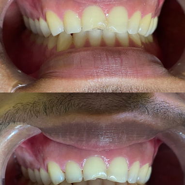 Limpiezas y Blanqueamientos dentales - 4/5