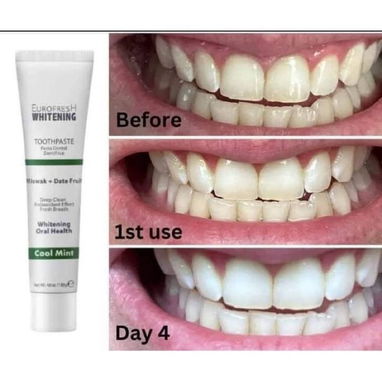 ¿Deseas blanquear nuevamente tus dientes? - Img 124297077