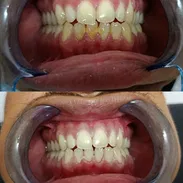 Blanqueamiento Dental - Img 55091657
