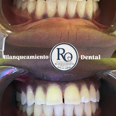 Limpiezas y Blanqueamientos Dentales - Img 127766422