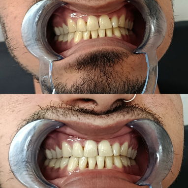 Limpiezas y Blanqueamientos Dentales - Img 122006895