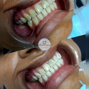 Blanqueamientos y Limpiezas Dentales - Img 56112148