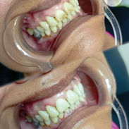 BLANQUEAMIENTO DENTAL - Img 55091736
