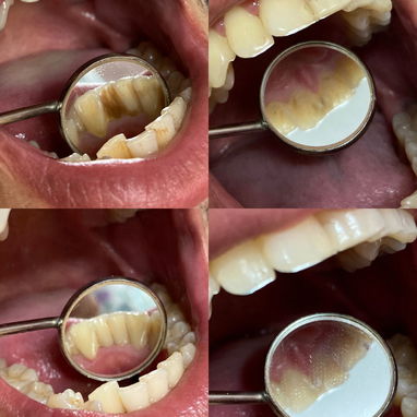 Limpieza y Blanqueamiento Dental Profesional - 2/2