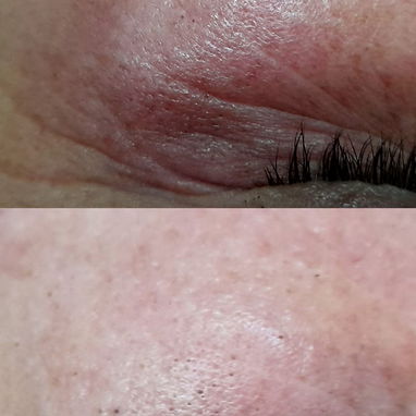 Limpieza Facial | Hidratación | Tratamiento para manchas, acné, lineas de expresión. . - Img 123246646