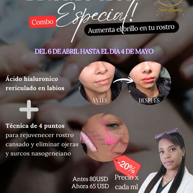 💉 Descubre el poder de la técnica de 4 puntos con ácido hialurónico y el aumento de labios en Spa Leydis. 🌸 - Img 122760798