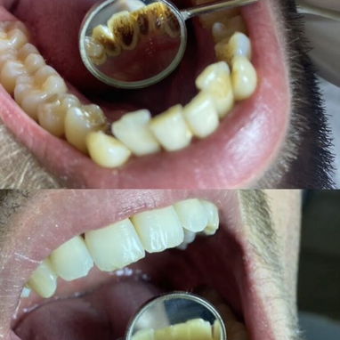 Limpiezas y blanqueamientos dentales - Img 122088718