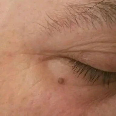Tratamientos anti acné manchas y arrugas y limpieza facial profunda - Img 119004623