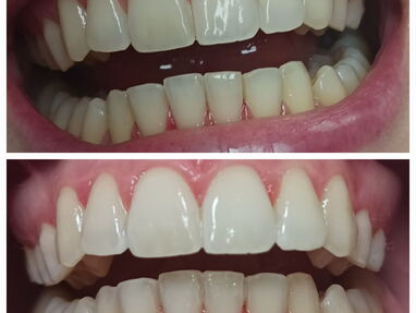 Limpiezas y blanqueamientos dentales realizadas por profesionales - Img 64381260