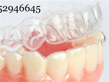 Retenedores de ortodoncia Ferula de Ortodoncia - Img 63012880