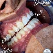 LIMPIEZAS Y BLANQUEAMIENTOS DENTALES - Img 56375359