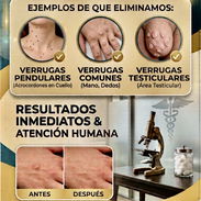 Eliminación de verrugas comunes y vulgares - Img 56430734
