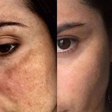 Jabon de Perla para manchas en todo el cuerpo - 2/2