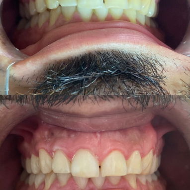 Limpiezas y blanqueamientos dentales - 4/4