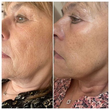 ⚡Botox instantáneo ⚡ - Img 124439411