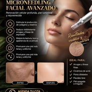 Microneedling, Dr.Pen, derma pen - Img 57690581