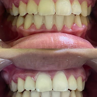 Limpiezas y Blanqueamientos dentales - 2/5