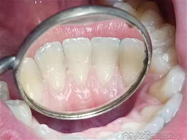 Limpiezas y blanqueamientos dentales realizadas por profesionales,le ayudamos a mejorar su sonrisa - Img 68682854
