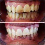 Servicio de Limpieza y Blanqueamiento Dental Profesional - Img 54854448