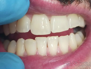 Limpiezas y blanqueamientos dentales realizadas por profesionales,le ayudamos a mejorar su sonrisa - Img 68682861
