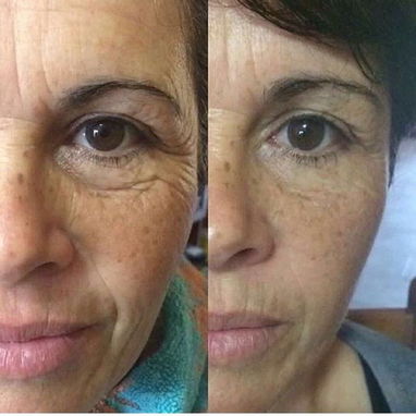 ⚡Botox instantáneo ⚡ - Img 124439412