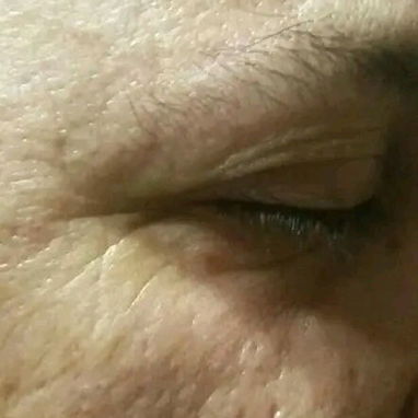 Tratamientos anti acné manchas y arrugas y limpieza facial profunda - Img 119004624
