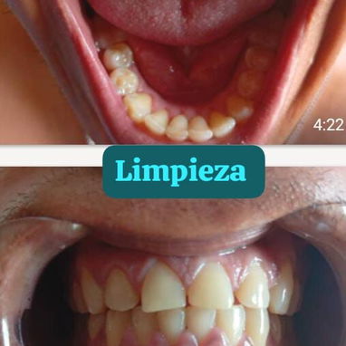 Se realiza limpieza dental y blanqueamiento - Img 124426538