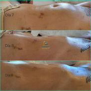 ✅ DRENAJE LINFÁTICO POST QUIRÚRGICO MASAJES POST OPERATORIO APARATOLOGIA ASESORÍA DOMICILIO GRATIS - Img 57149759