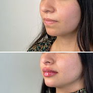 Aumento y definición de labios con Ácido Hialurónico - Img 57692620