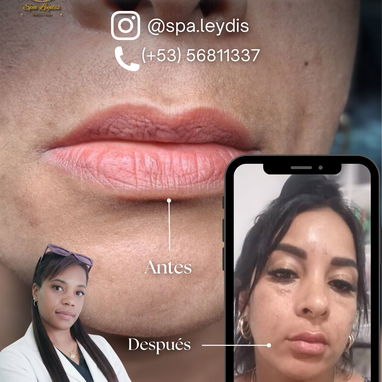 Oferta de verano en el servicio de acido hialurónico en spa_leydis . Marianao - Img 124281850