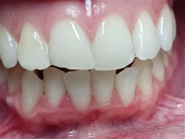 Limpiezas y blanqueamientos dentales realizadas por profesionales,le ayudamos a mejorar su sonrisa - Img 68682856