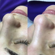 LIMPIEZA FACIAL CON APARATOLOGIA - Img 54842521
