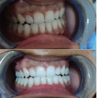 Blanqueamiento y limpieza dental - Img 127132748