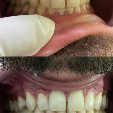 Limpiezas y blanqueamientos dentales - 3/4