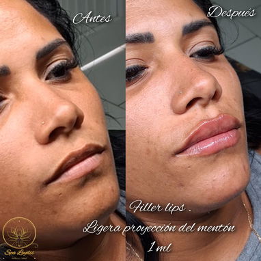 Oferta de verano en el servicio de acido hialurónico en spa_leydis . Marianao - Img 124281851