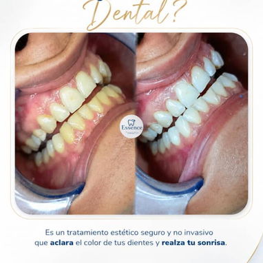 Limpieza y Blanqueamiento Dental Profesional - Img 127925464
