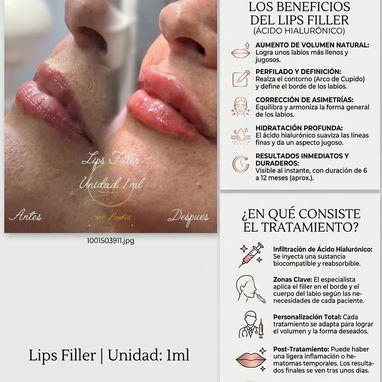 OFERTA DE VERANO EN EL SERVICIO DE ÁCIDO HIALURÓNICO. DESCUENTO DEL 10% - Img 125575810