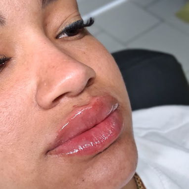 Aumento de labios con ácido hialurónico en Spa_leydis🪷 Marianao. Resalta su belleza de forma natural - Img 128015152