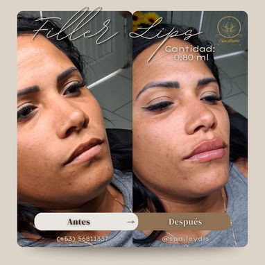 💉 Descubre el poder de la técnica de 4 puntos con ácido hialurónico y el aumento de labios en Spa Leydis Marianao 🌸 - Img 121800210