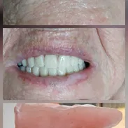 Prótesis Dental parciales y totales removible de acrílico - Img 55665700