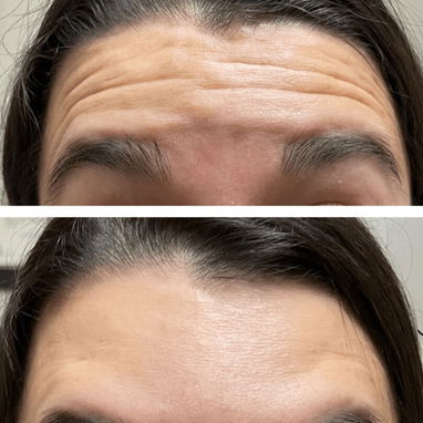 Aplicación de Botox - 3/3