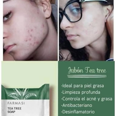 🌿 JABÓN DE TEA TREE 🌿 Ideal para acné y pieles grasas 🌿 - Img 124116437