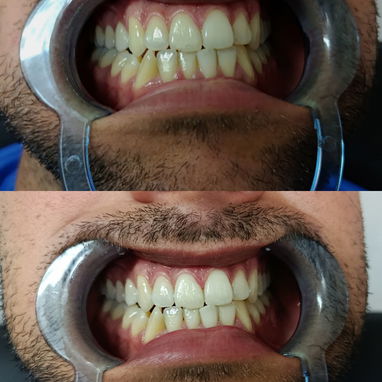 Blanqueamiento Dental - Img 120018302