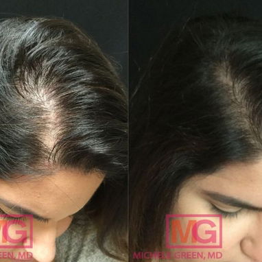 Minoxidil 5% caída de cabello recuperar el pelo alopecia calvicie - Img 117739103