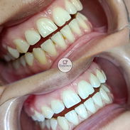BLANQUEAMIENTOS Y LIMPIEZAS DENTALES - Img 56942553