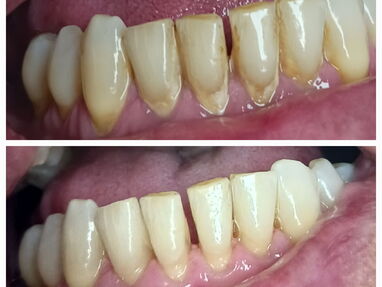 Limpiezas y blanqueamientos dentales realizadas por profesionales - Img 64381261