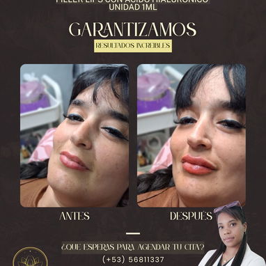 Aumento de labios con ácido hialurónico en Spa_leydis🪷 Marianao. Resalta su belleza de forma natural - Img 128014950