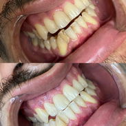 Limpieza y Blanqueamiento Dental Profesional - Img 57074993